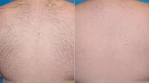 Before and after laser hair removal on back