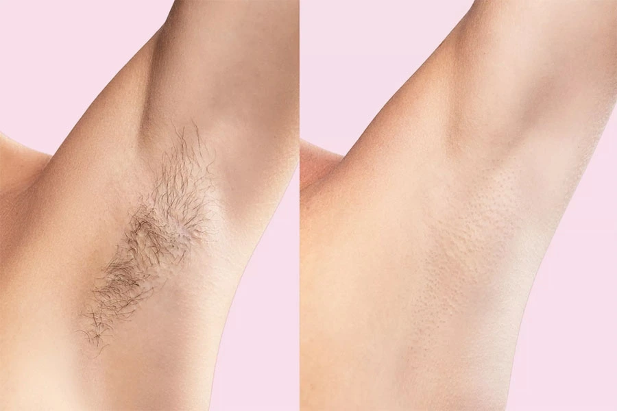 Before and after laser hair removal of armpit