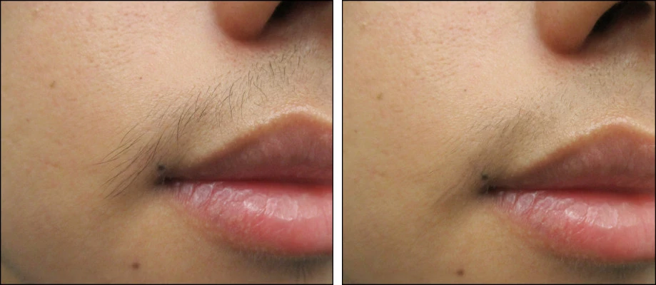 Before and after laser hair removal of facial hair